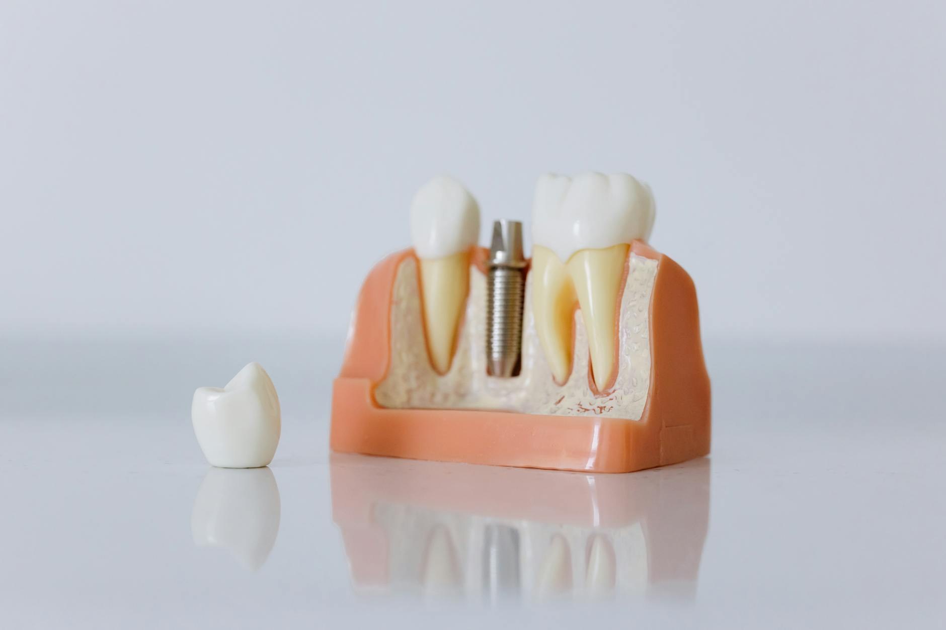 Implante dental titanio