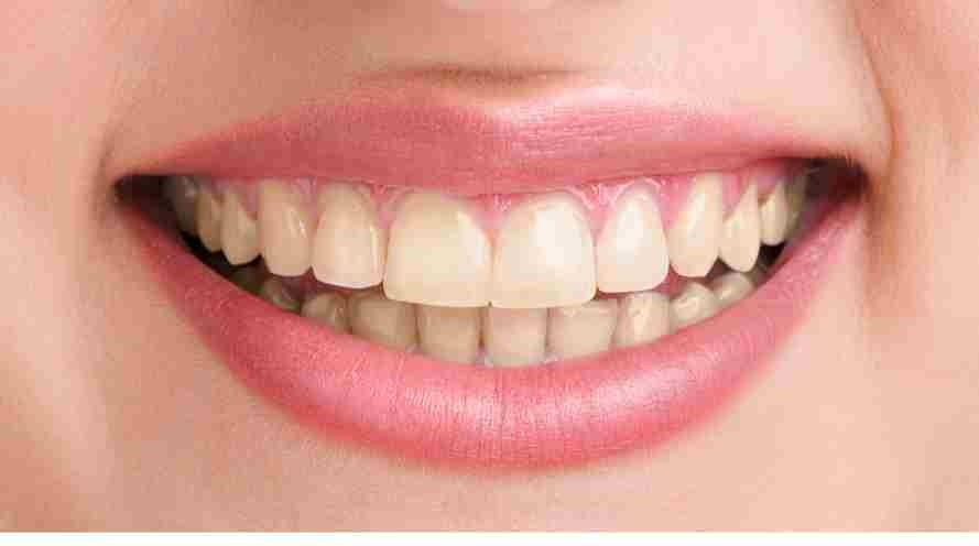 Sonrisa antes del blanqueamiento dental — dientes con pigmentación