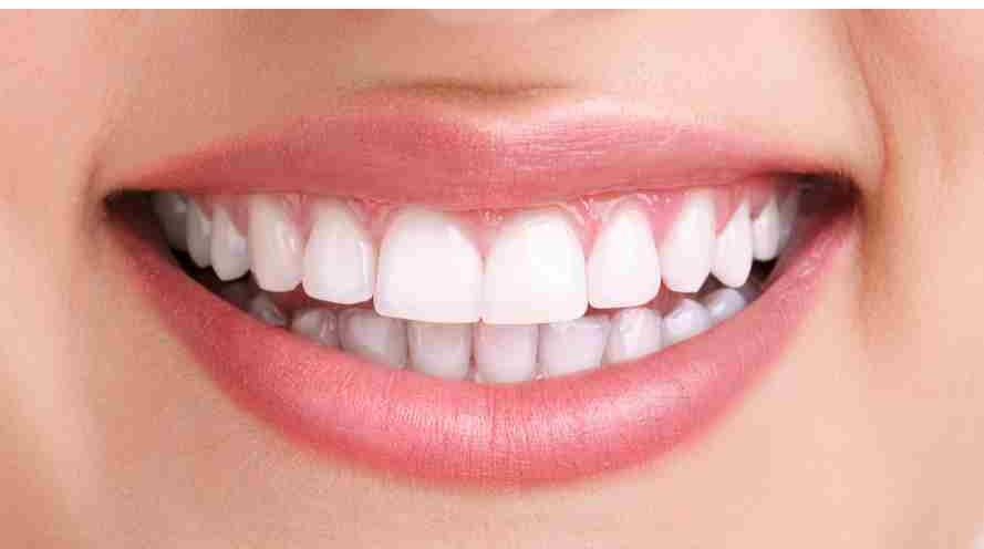 Sonrisa después del blanqueamiento dental — dientes blancos y brillantes